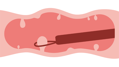 ポリープをその場で切除可能